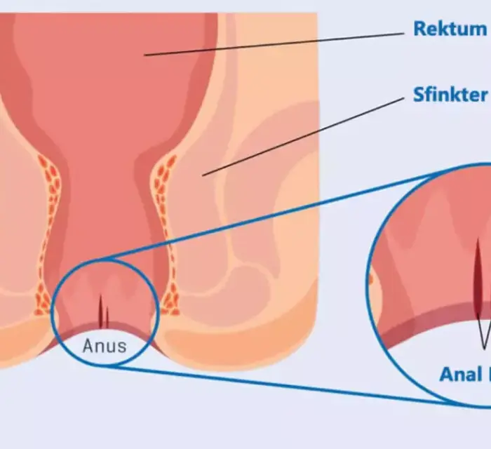 Anal Fissür Belirtileri | İlk Belirtiler, Ağrı ve Kanama Rehberi